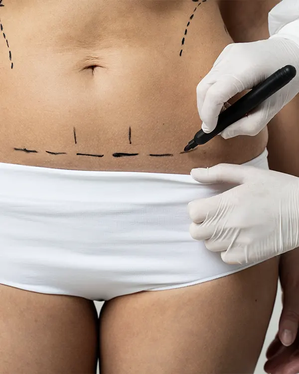 img-abdominoplastia-en-pereira-1