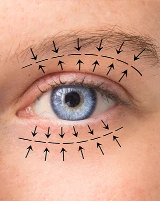 img-blefaroplastia-en-pereira-1-LCP