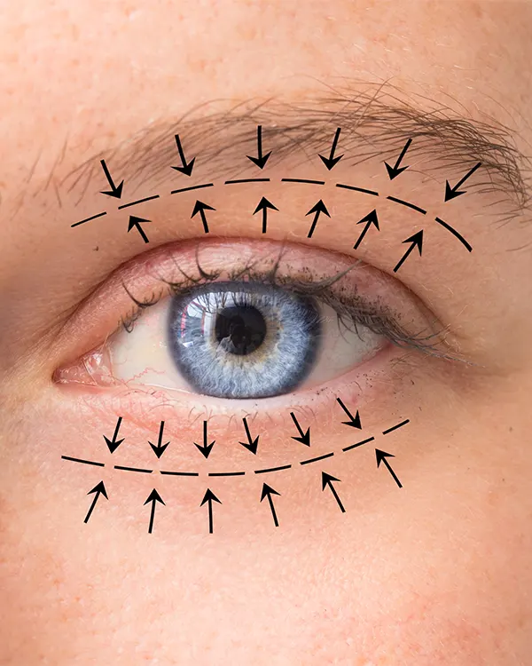 img-blefaroplastia-en-pereira-1