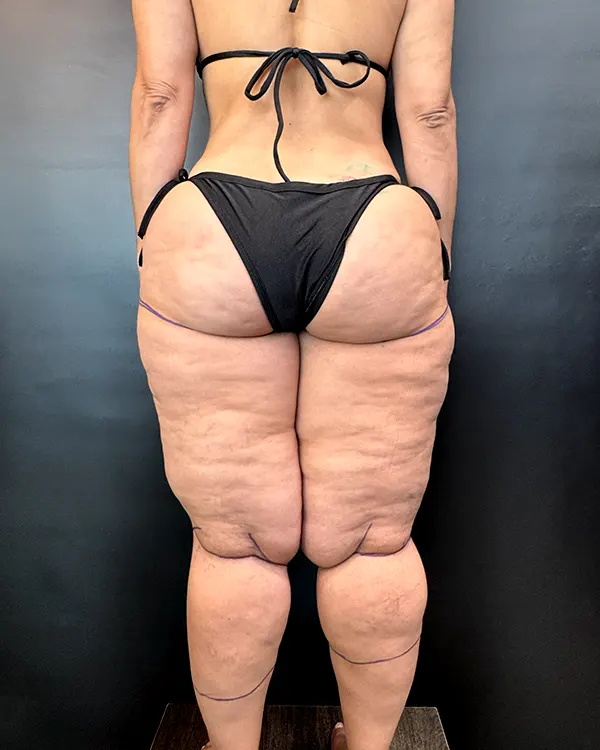 img-lipedema-en-pereira-2